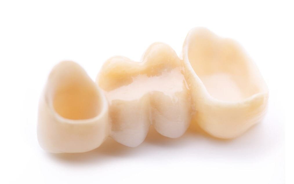 dental-bridge-team-smile-dentistry-fontham-pelham-general-and-family-dentist Dental Bridges | Team Smile Dentistry | General & Family Dentist | Fonthill | Ontario