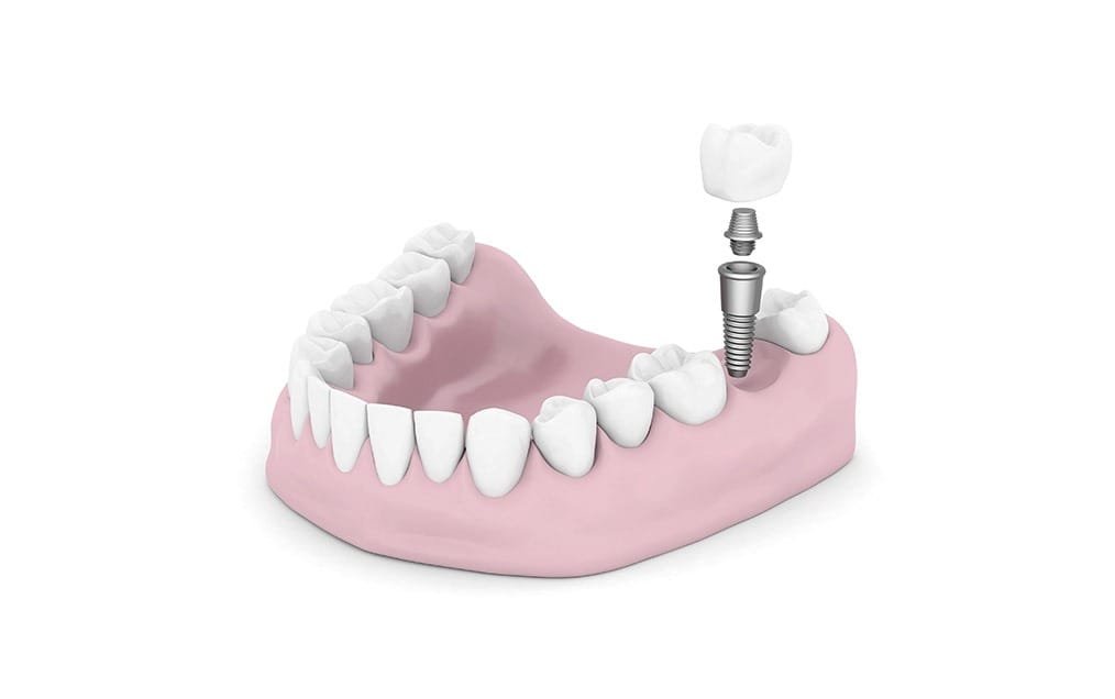 dental-implant-crown-team-smile-dentistry-fontham-pelham-general-and-family-dentist Dental Implant Crowns | Team Smile Dentistry | General & Family Dentist | Fonthill | Ontario