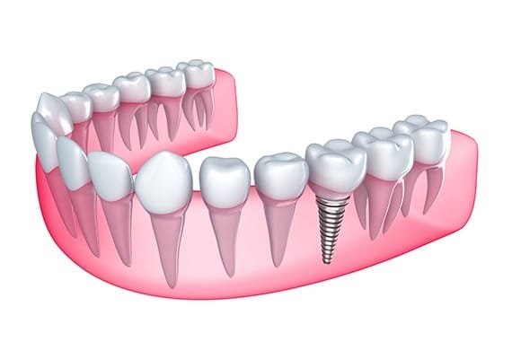 dental-implant-crowns-team-smile-dentistry-fontham-pelham-general-and-family-dentist Dental Implant Crowns | Team Smile Dentistry | General & Family Dentist | Fonthill | Ontario