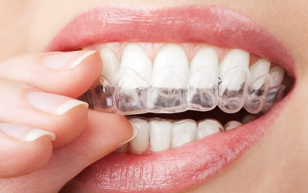 imgpsh_fullsize_anim (3) Invisalign® Clear Aligners | Team Smile Dentistry | General & Family Dentist | Fonthill | Ontario