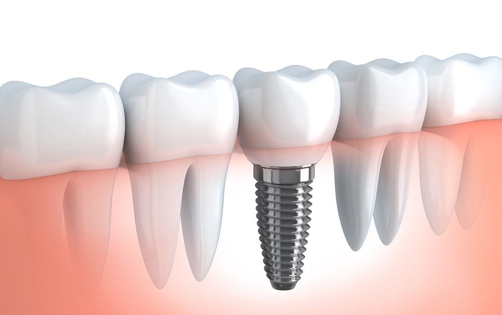 implant-dentistry-team-smile-dentistry-fontham-pelham-general-and-family-dentist Implant Dentistry | Team Smile Dentistry | General & Family Dentist | Fonthill | Ontario