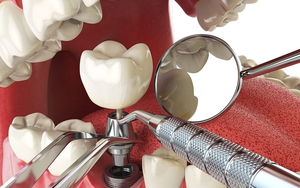 implant-placement-surgery-team-smile-dentistry-fontham-pelham-general-and-family-dentist Implant Placement Surgery | Team Smile Dentistry | General & Family Dentist | Fonthill | Ontario