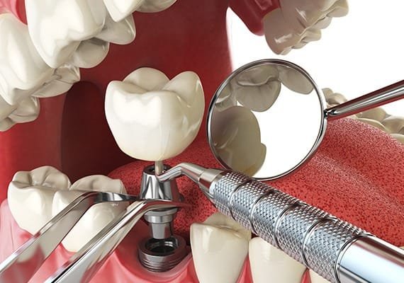 implant-placement-surgery-team-smile-dentistry-fontham-pelham-general-and-family-dentist Implant Placement Surgery | Team Smile Dentistry | General & Family Dentist | Fonthill | Ontario