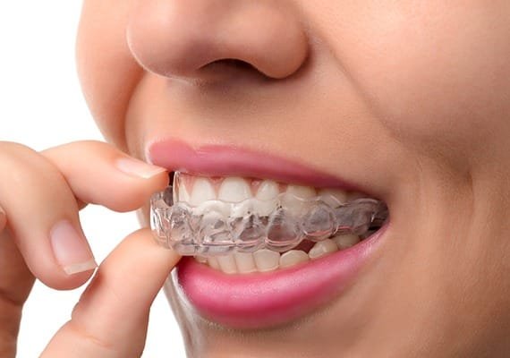 invisalign-clear-aligners-team-smile-dentistry-fontham-pelham-general-and-family-dentist Invisalign® Clear Aligners | Team Smile Dentistry | General & Family Dentist | Fonthill | Ontario