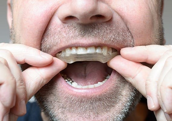 night-guards-team-smile-dentistry-fontham-pelham-general-and-family-dentist Night Guards | Team Smile Dentistry | General & Family Dentist | Fonthill | Ontario