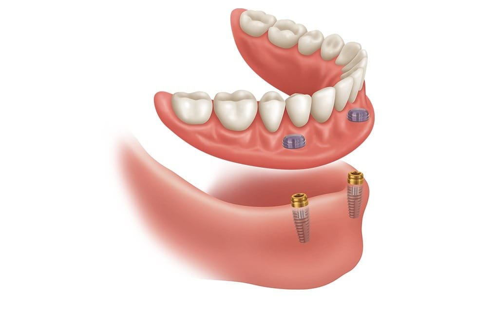 over-denture-implant-team-smile-dentistry-fontham-pelham-general-and-family-dentist Over Denture Implants | Team Smile Dentistry | General & Family Dentist | Fonthill | Ontario