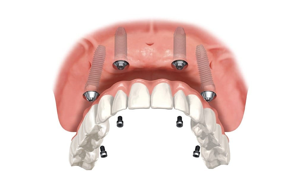 over-denture-implants-team-smile-dentistry-fontham-pelham-general-and-family-dentist Over Denture Implants | Team Smile Dentistry | General & Family Dentist | Fonthill | Ontario