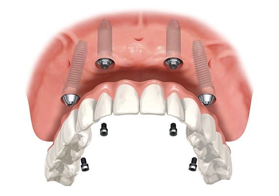 over-denture-implants-team-smile-dentistry-fontham-pelham-general-and-family-dentist Over Denture Implants | Team Smile Dentistry | General & Family Dentist | Fonthill | Ontario