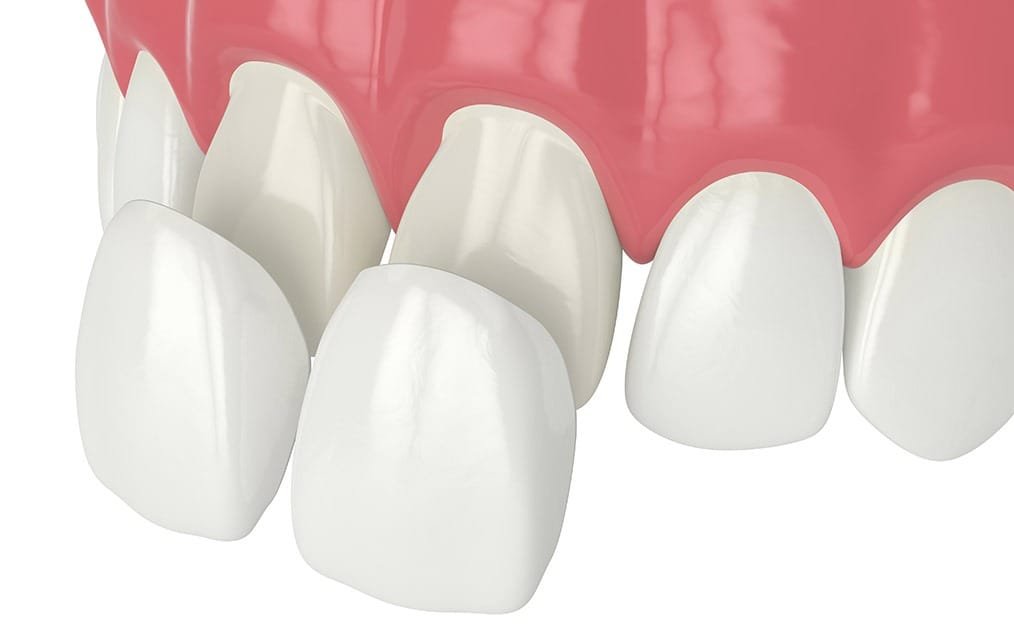 porcelain-veneers-service-team-smile-dentistry-fontham-pelham-general-and-family-dentist Porcelain Veneers | Team Smile Dentistry | General & Family Dentist | Fonthill | Ontario