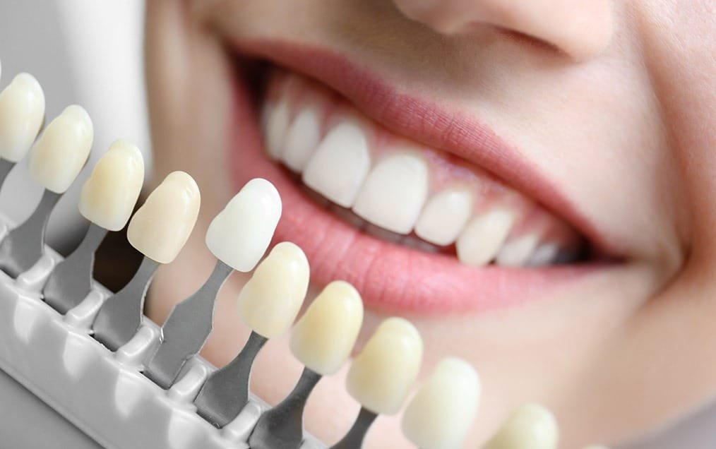 porcelain-veneers-team-smile-dentistry-fontham-pelham-general-and-family-dentist Porcelain Veneers | Team Smile Dentistry | General & Family Dentist | Fonthill | Ontario