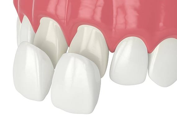 porcelain-veneers-team-smile-dentistry-fontham-pelham-general-and-family-dentist Porcelain Veneers | Team Smile Dentistry | General & Family Dentist | Fonthill | Ontario