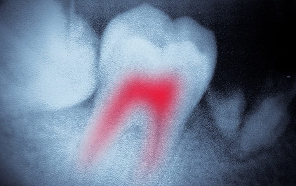 Root Canal Therapy Team Smile Dentistry | General & Family Dentist | Fonthill | Ontario