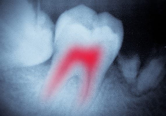 Root Canal Therapy | Team Smile Dentistry | General & Family Dentist | Fonthill | Ontario