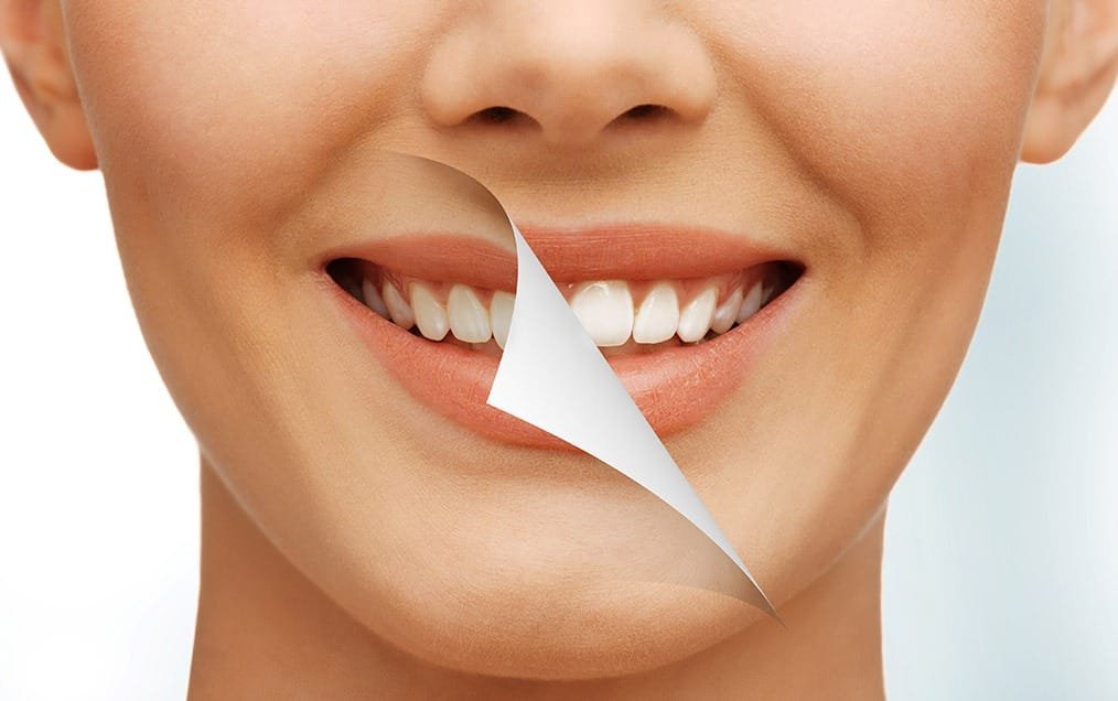 teeth-whitening-team-smile-dentistry-fontham-pelham-general-and-family-dentist Teeth Whitening | Team Smile Dentistry | General & Family Dentist | Fonthill | Ontario