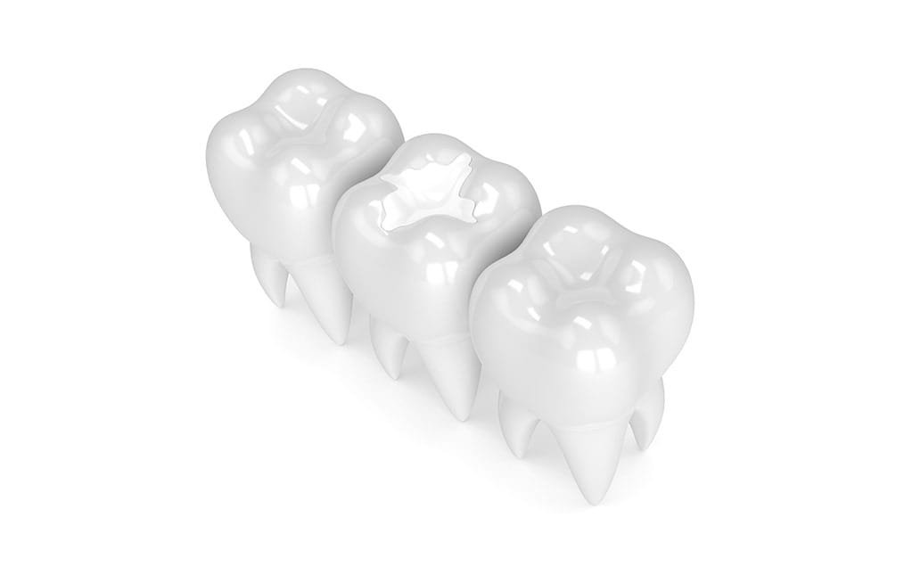 tooth-coloured-fillings-services-team-smile-dentistry-fontham-pelham-general-and-family-dentist Tooth Coloured Fillings | Team Smile Dentistry | General & Family Dentist | Fonthill | Ontario