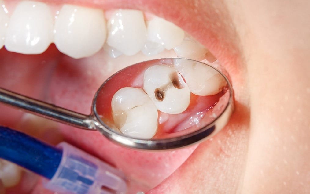 Tooth Coloured Fillings | Team Smile Dentistry | General & Family Dentist | Fonthill | Ontario