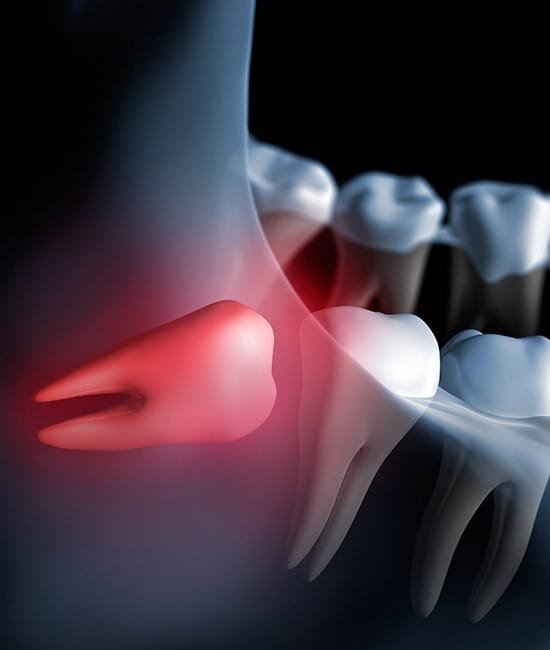 wisdom-teeth-extraction-team-smile-dentistry-fontham-pelham-general-and-family-dentist