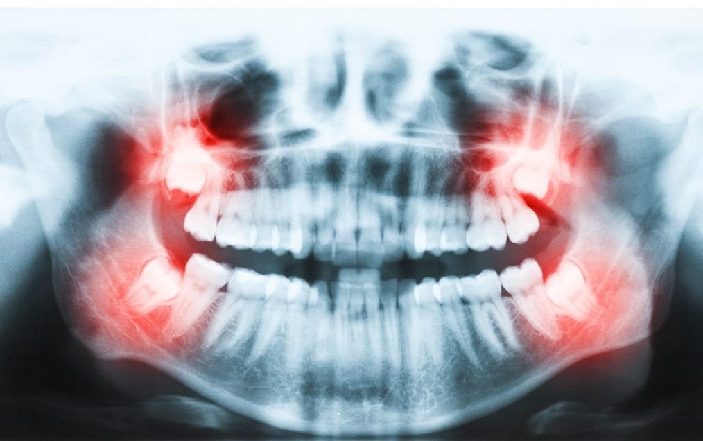 wisdom-teeth-extraction-team-smile-dentistry-fontham-pelham-general-and-family-dentist Wisdom Teeth Extraction | Team Smile Dentistry | General & Family Dentist | Fonthill | Ontario