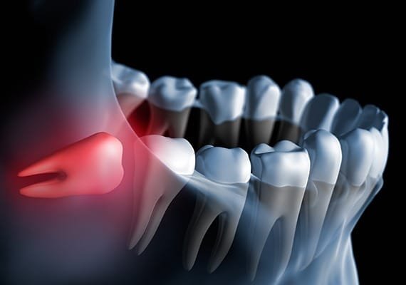 wisdom-teeth-extraction-team-smile-dentistry-fontham-pelham-general-and-family-dentist Wisdom Teeth Extraction | Team Smile Dentistry | General & Family Dentist | Fonthill | Ontario